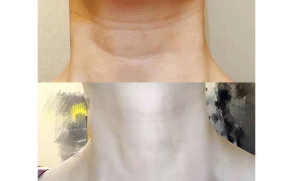 嗨體可以長期使用嗎？