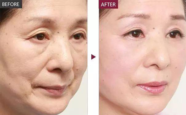 膠原蛋白除皺的適應(yīng)人群？