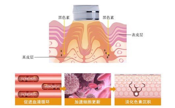 光子嫩膚效果好不好？