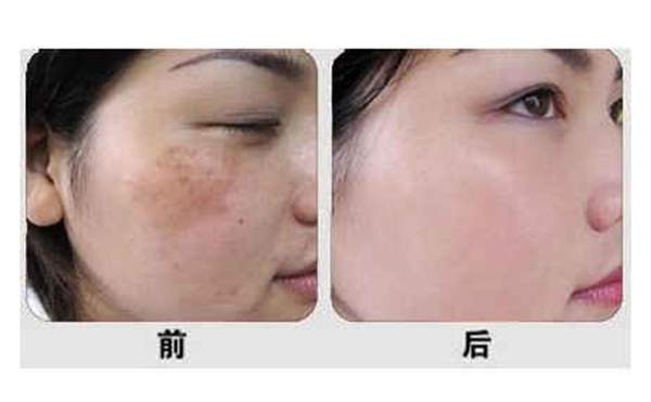 光子嫩膚有什么優(yōu)勢(shì)？
