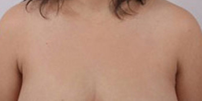 手術去副乳術后