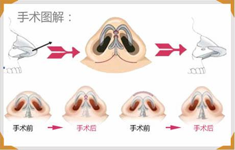 縮鼻頭手術(shù)可以保持多久？縮鼻頭手術(shù)術(shù)后注意事項？