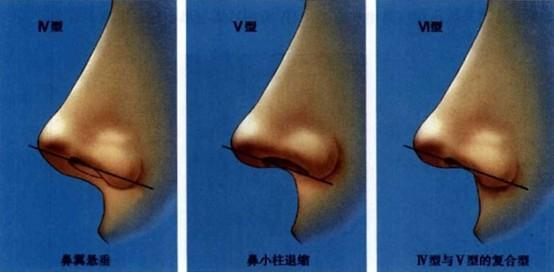 鼻小柱延長術(shù)一般價(jià)位多少錢？做鼻小柱延長術(shù)有什么不好的影響嗎？