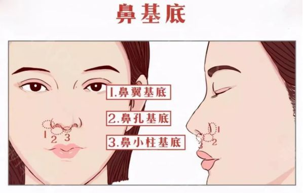 自體脂肪填充鼻基底好不好？鼻基底脂肪填充多久恢復(fù)？