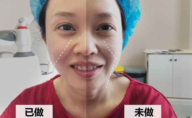 激光溶脂瘦臉的副作用及效果？光纖溶脂瘦臉多久可以見效？