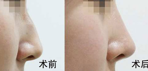 駝峰鼻矯正的方法有哪些？駝峰鼻矯正的方式及適合人群？