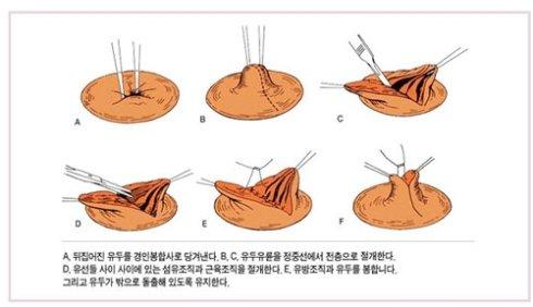 乳頭內(nèi)陷矯正手術(shù)多少錢？乳頭內(nèi)陷矯正手術(shù)多久可以恢復(fù)？