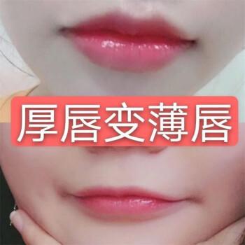 厚唇改薄整形手術(shù)價格？厚唇改薄多久完全恢復(fù)？