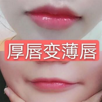 厚唇改薄整形手術(shù)價(jià)格？厚唇改薄多久完全恢復(fù)？