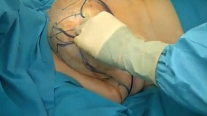 乳房縮小手術(shù)要多少錢？乳房縮小術(shù)是大手術(shù)嗎？