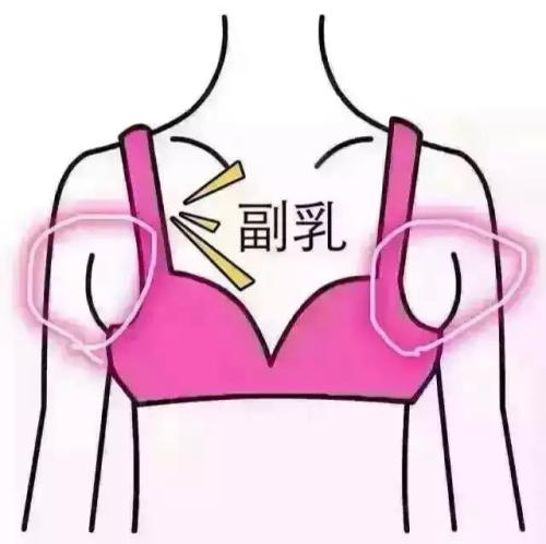 吸脂做副乳要多少錢？吸脂去副乳會反彈嗎？