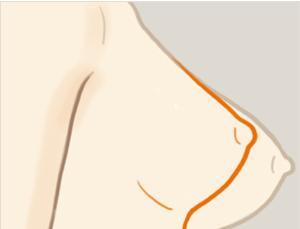 乳房下垂矯正手術(shù)風(fēng)險(xiǎn)有多大？ 乳房下垂矯正術(shù)多久能恢復(fù)？