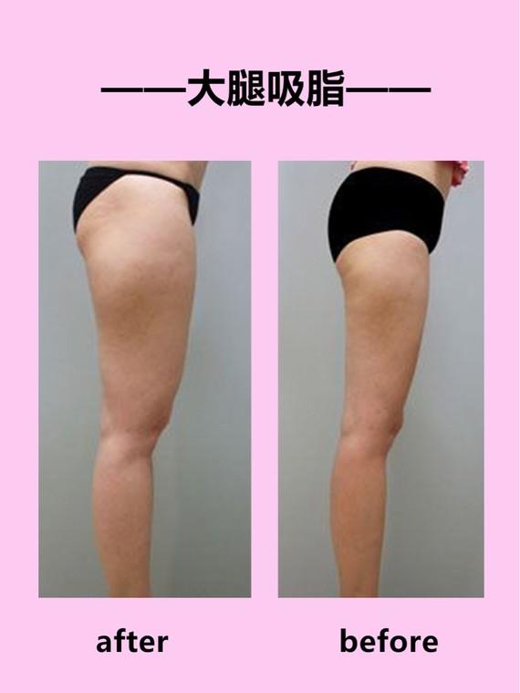 吸脂瘦大腿腫脹期是多久？大腿吸脂有什么后遺癥嗎？