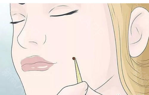 激光點痣要多久才會恢復(fù)？激光點痣多少錢？