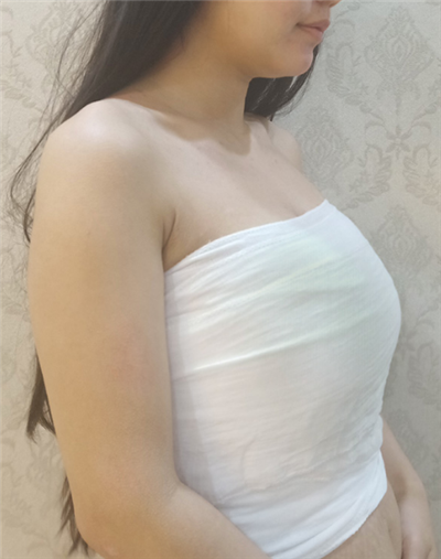 慈溪悅爾醫(yī)學美容醫(yī)院做隆胸手術前的胸部