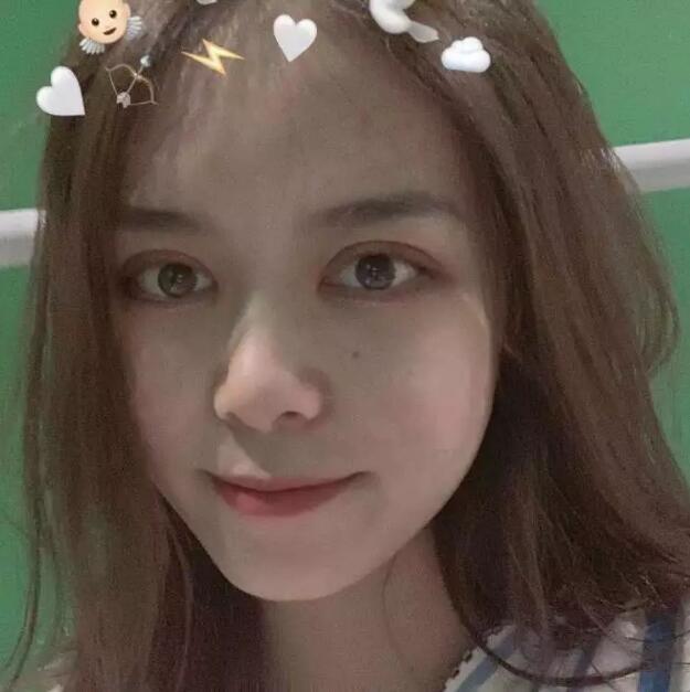 鄭州壹加壹王洛生全切雙眼皮案例術后一個月