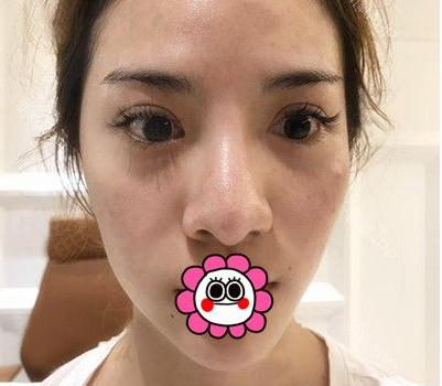 有“鼻王”之稱的楊群申做鼻子到底怎么樣？隆鼻前后圖片