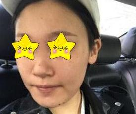 隆鼻真實案例，長沙亞韓鄭京湘隆鼻前后對比圖片