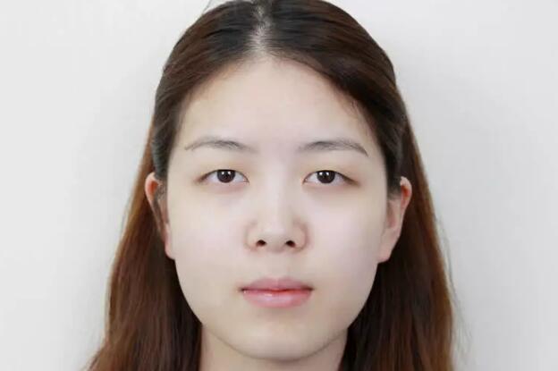 鄭州壹加壹王洛生全切雙眼皮案例術前