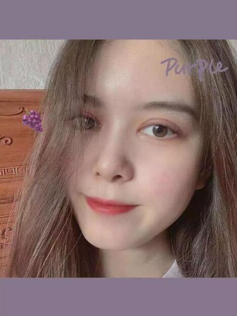 鄭州壹加壹王洛生全切雙眼皮案例術后三個月