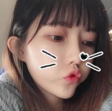 做雙眼皮案例，第四軍醫(yī)大學(xué)唐都醫(yī)院李望舟雙眼皮案例圖片
