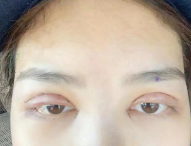鄭州壹加壹王洛生全切雙眼皮案例術后第二天