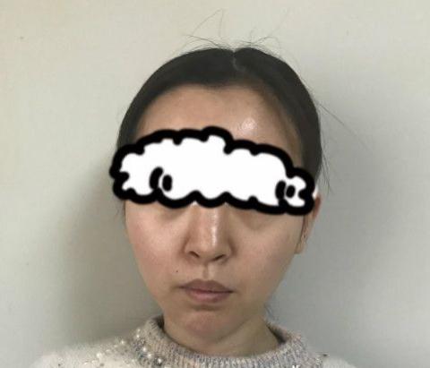 北京聯(lián)合麗格卓彥醫(yī)療趙瓊隆鼻失敗修復手術(shù)案例術(shù)前