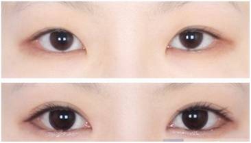 桂林柏琳整形開內(nèi)眼角多少錢？開內(nèi)眼角注意哪些?