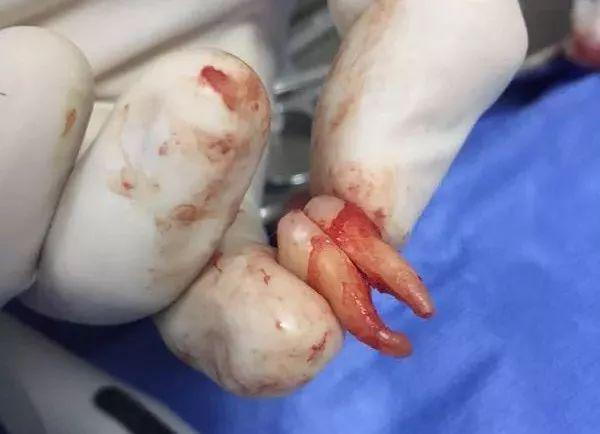 福州登特口腔拔智齒有哪些利弊？拔智齒有哪些情況？
