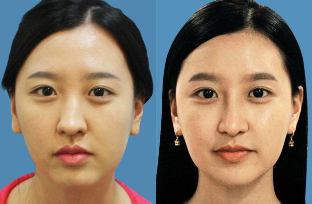 面部不對稱可以怎么矯正？臉一邊大一邊小怎么矯正？