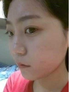 上海時光整形外科醫(yī)院趙克昶做耳軟骨隆鼻案例效果分享