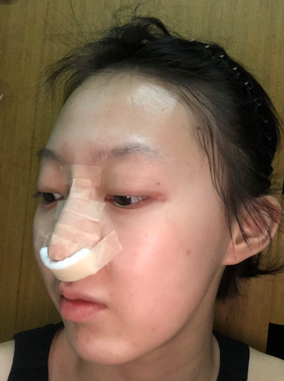南京美貝爾醫(yī)療美容醫(yī)院做自體軟骨隆鼻術后要進行拆線